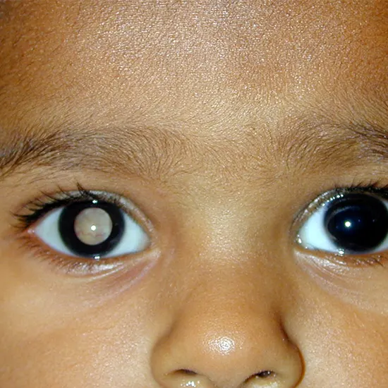 Shine a light on retinoblastoma : Early detection saves lives!